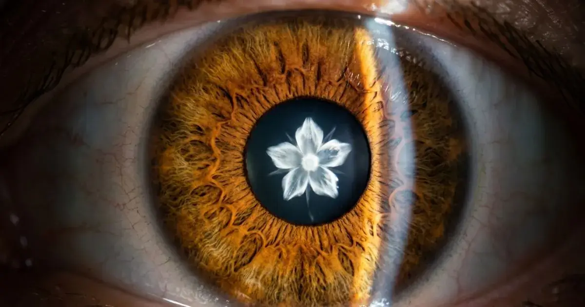 Rosette Cataract - Causes, Symptoms & Treatment